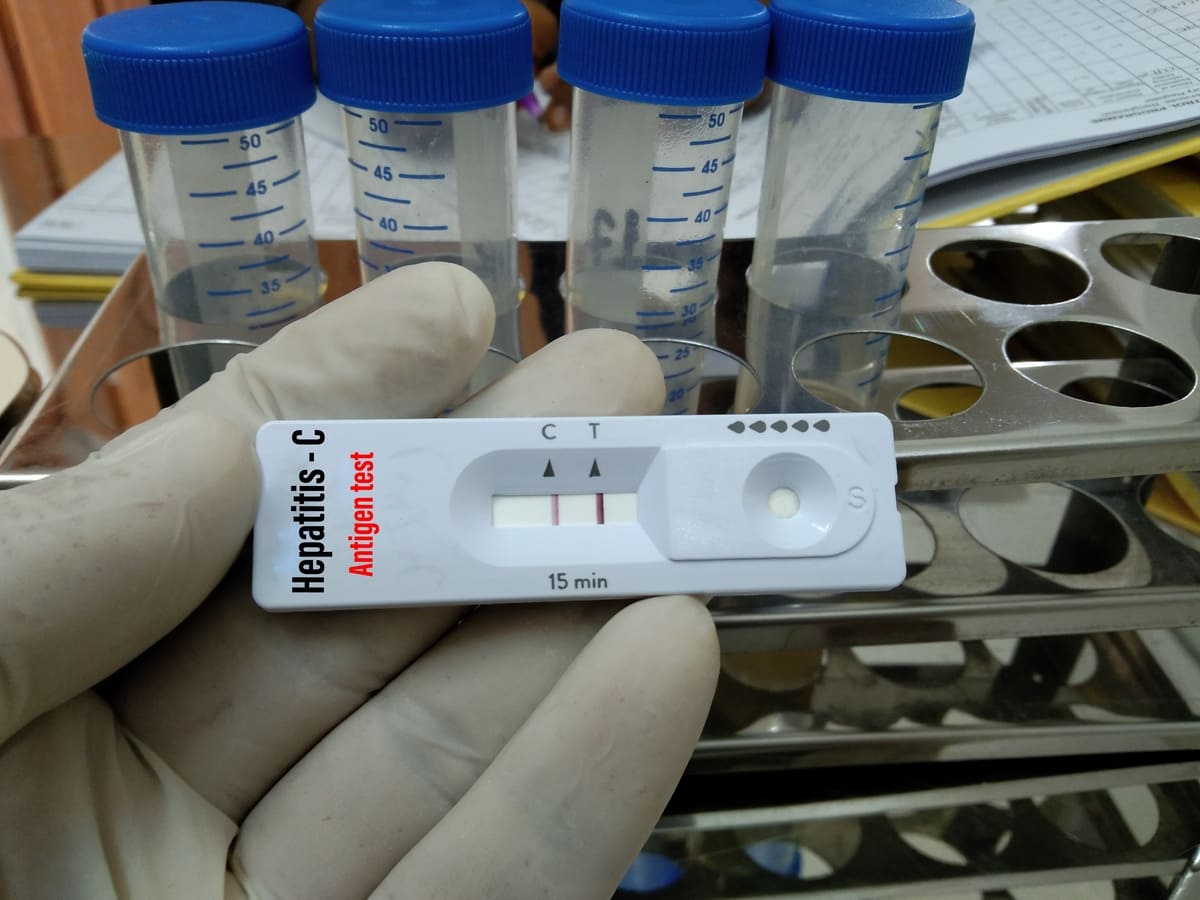 Logros en la lucha contra la Hepatitis C en México más de 22 mil personas curadas