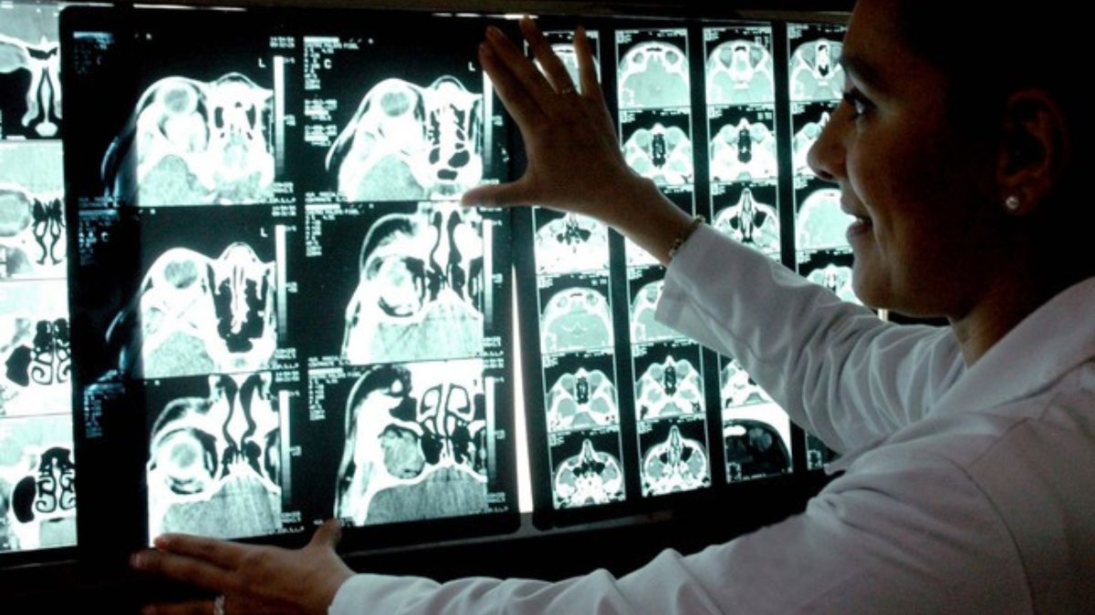 Capacitan a 3.000 profesionales de salud en México para mejorar el diagnóstico temprano del ictus