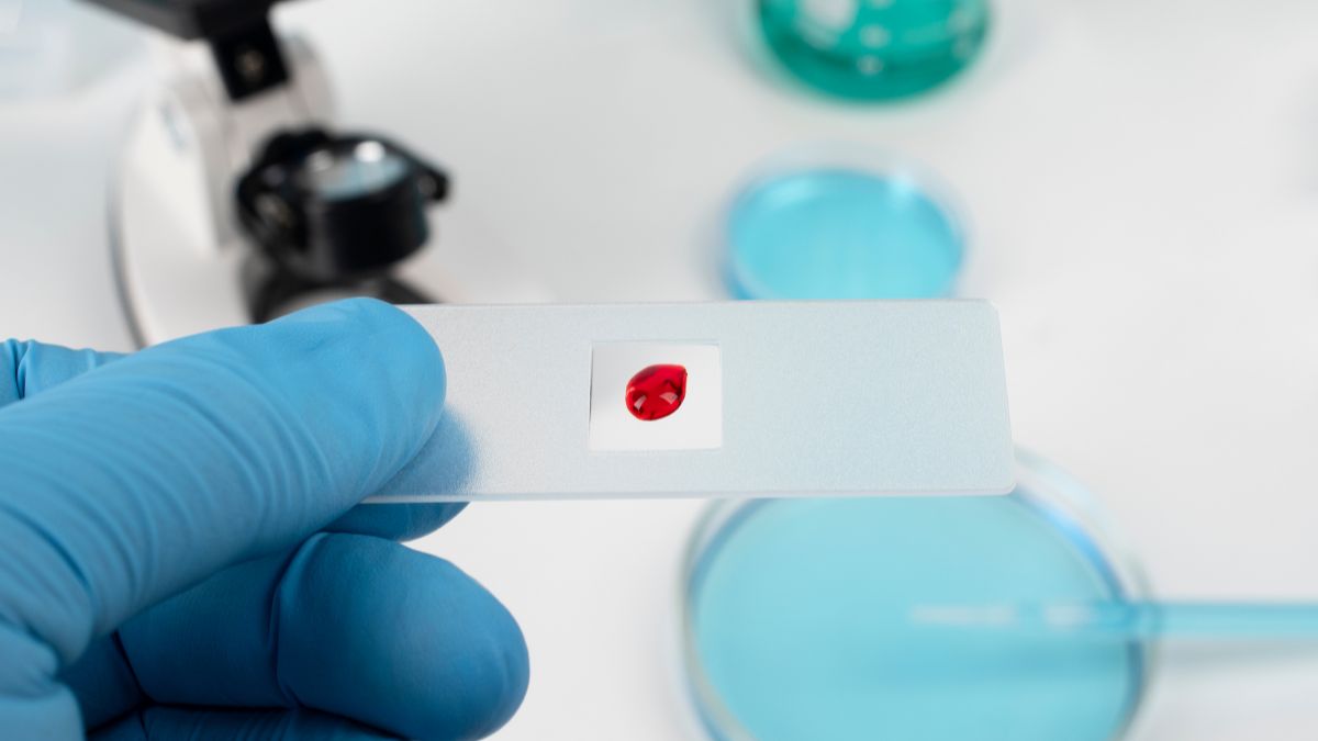 Dónde hacerse la prueba de VIH gratis en Ciudad de México: diagnóstico y tratamiento oportuno