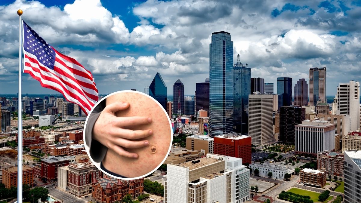 Texas declara oficialmente el fin del brote de sarampión tras afectar a 762 personas y provocar dos muertes infantiles