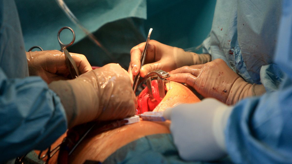 Trasplante de pulmón de cerdo modificado genéticamente en humanos: un hito en el xenotrasplante con grandes retos por superar