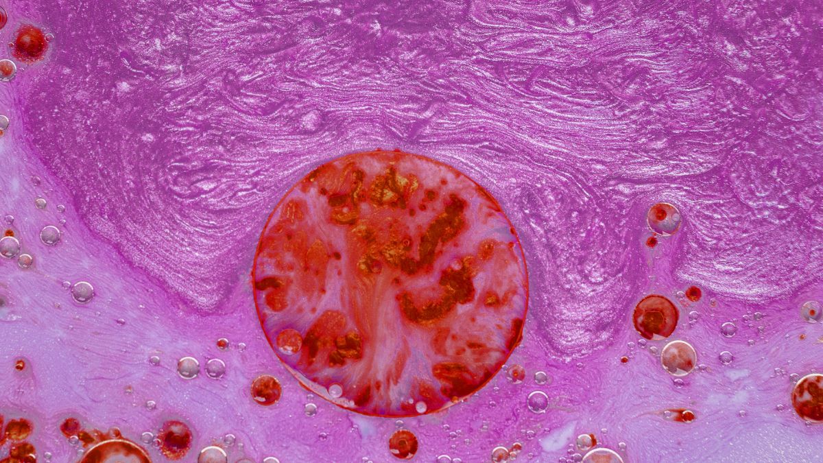 Avances médicos han duplicado la sobrevida en pacientes con mieloma múltiple en México