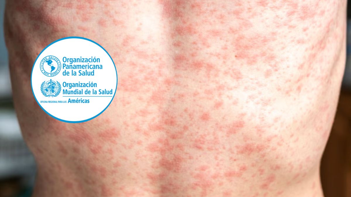 OPS alerta por más de 11 mil casos de Sarampión y llama a reforzar la vacunación en la Américas