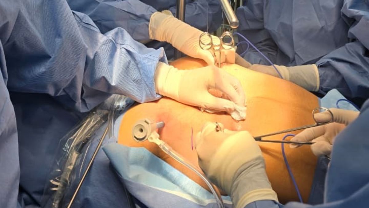 ISSSTE e IMSS realizan primera cirugía de corrección de pecho hundido con técnica de mínima invasión en el CMN “20 de Noviembre”