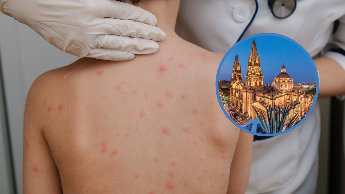 Jalisco rebasa los 200 contagios de sarampión y refuerza vigilancia en municipios rurales