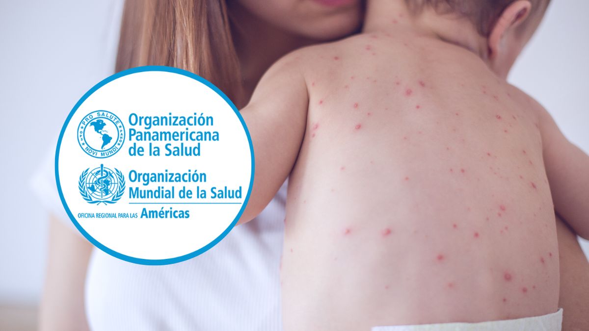 Las Américas enfrentan nuevo reto sanitario: OPS confirma regreso del sarampión endémico