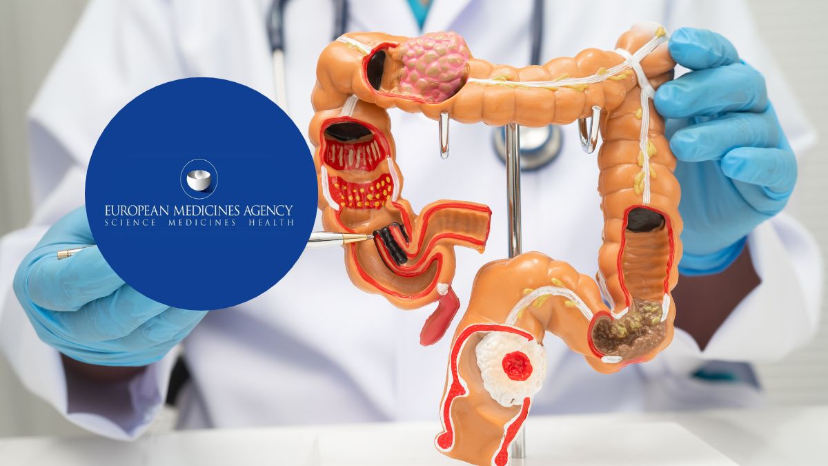EMA recomienda tratamiento basado en inmunoterapia para el cáncer anal avanzado