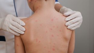 Alerta sanitaria por sarampión en México más de 2.400 casos y 9 muertes confirmadas