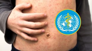 Brotes de sarampión en 59 países evidencian fragilidad de la cobertura vacunal mundial