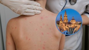 Jalisco rebasa los 200 contagios de sarampión y refuerza vigilancia en municipios rurales