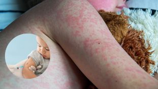 México enfrenta el mayor brote de sarampión en décadas: ya son cuatro los menores fallecidos y más de mil casos confirmados