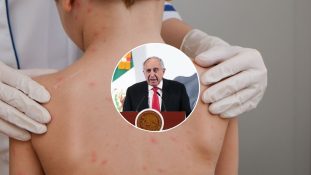 México refuerza su respuesta al brote de sarampión con comité de expertos multidisciplinario