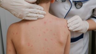 México supera 36.4 millones de dosis aplicadas contra sarampión y refuerza la vacunación en población infantil
