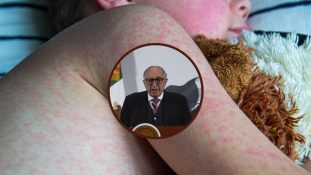 México refuerza estrategia nacional contra el brote de sarampión