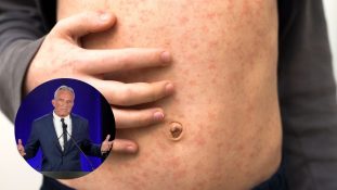 Robert F. Kennedy Jr. defiende gestión de brotes de sarampión en EE. UU., "México está peor" insinúa